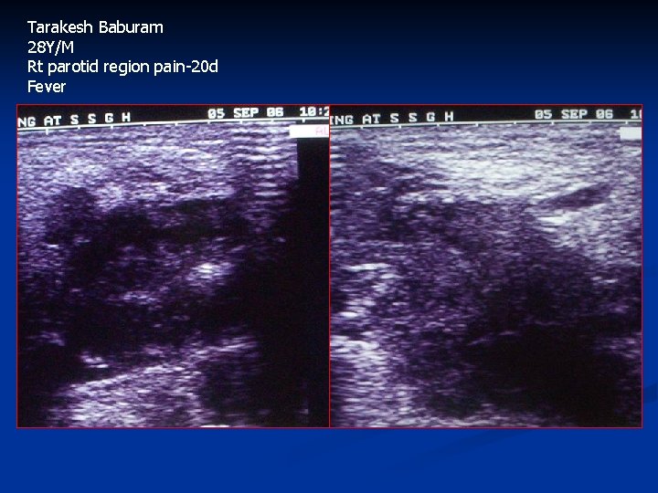 Tarakesh Baburam 28 Y/M Rt parotid region pain-20 d Fever 
