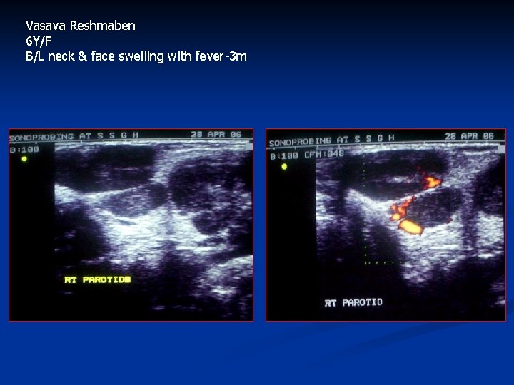 Vasava Reshmaben 6 Y/F B/L neck & face swelling with fever-3 m 