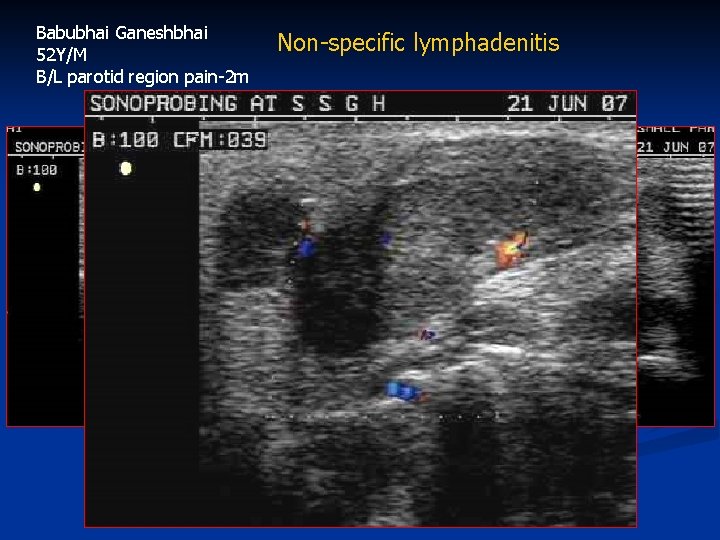 Babubhai Ganeshbhai 52 Y/M B/L parotid region pain-2 m Non-specific lymphadenitis 