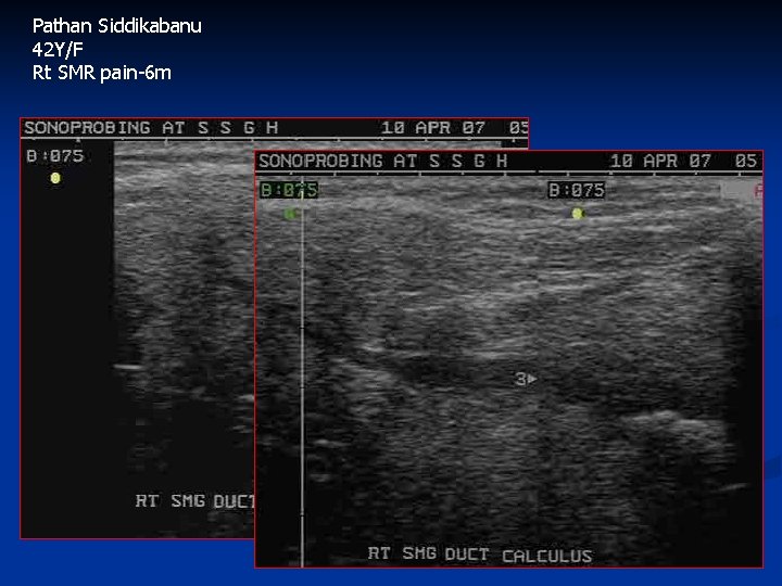 Pathan Siddikabanu 42 Y/F Rt SMR pain-6 m 