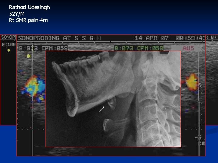 Rathod Udesingh 52 Y/M Rt SMR pain-4 m 