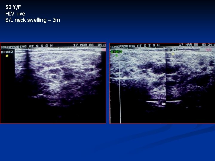 50 Y/F HIV +ve B/L neck swelling – 3 m 