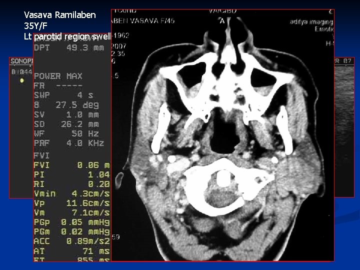Vasava Ramilaben 35 Y/F Lt parotid region swelling-1 y 