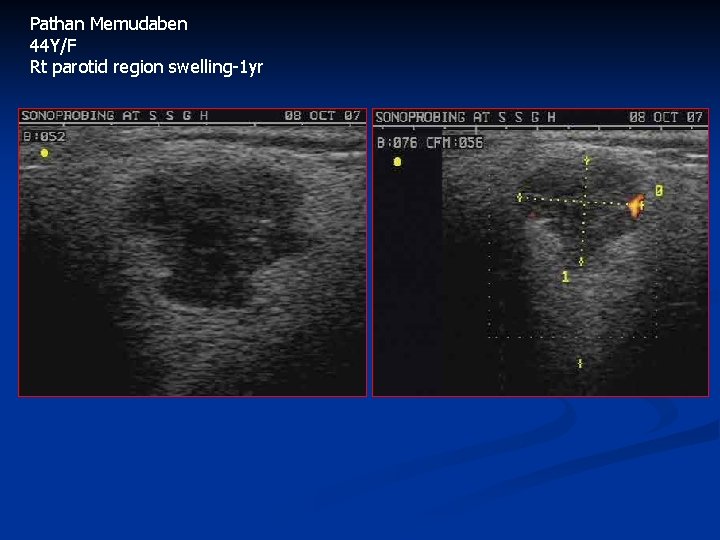 Pathan Memudaben 44 Y/F Rt parotid region swelling-1 yr 