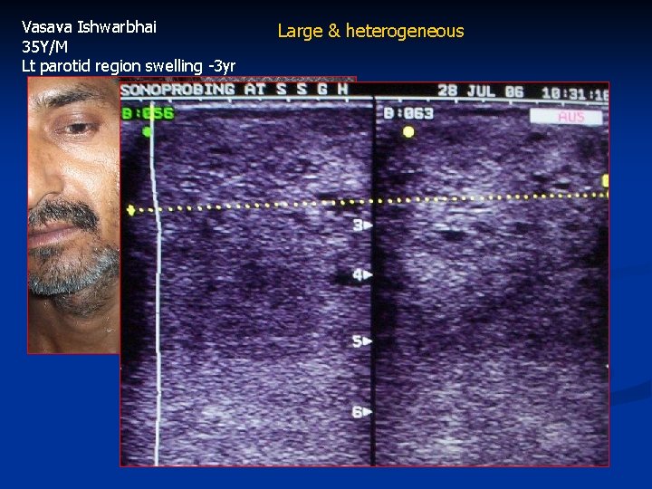 Vasava Ishwarbhai 35 Y/M Lt parotid region swelling -3 yr Large & heterogeneous 