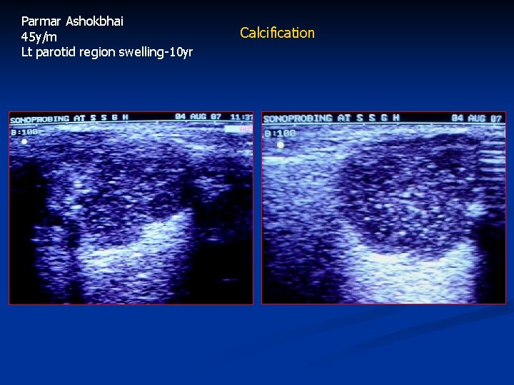 Parmar Ashokbhai 45 y/m Lt parotid region swelling-10 yr Calcification 