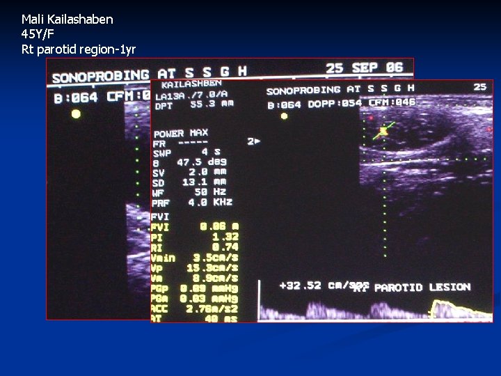 Mali Kailashaben 45 Y/F Rt parotid region-1 yr 