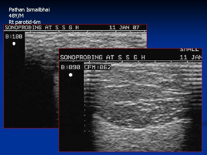 Pathan Ismailbhai 48 Y/M Rt parotid-6 m 