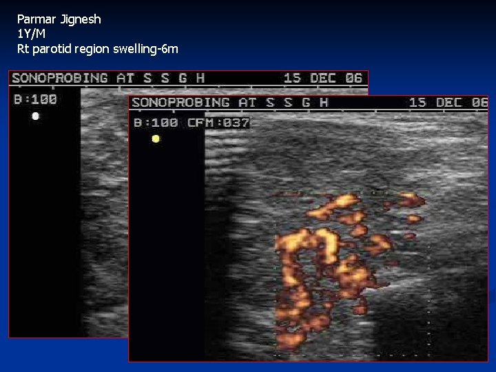 Parmar Jignesh 1 Y/M Rt parotid region swelling-6 m 