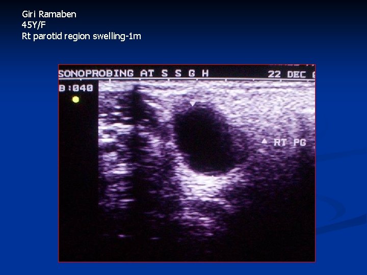 Giri Ramaben 45 Y/F Rt parotid region swelling-1 m 