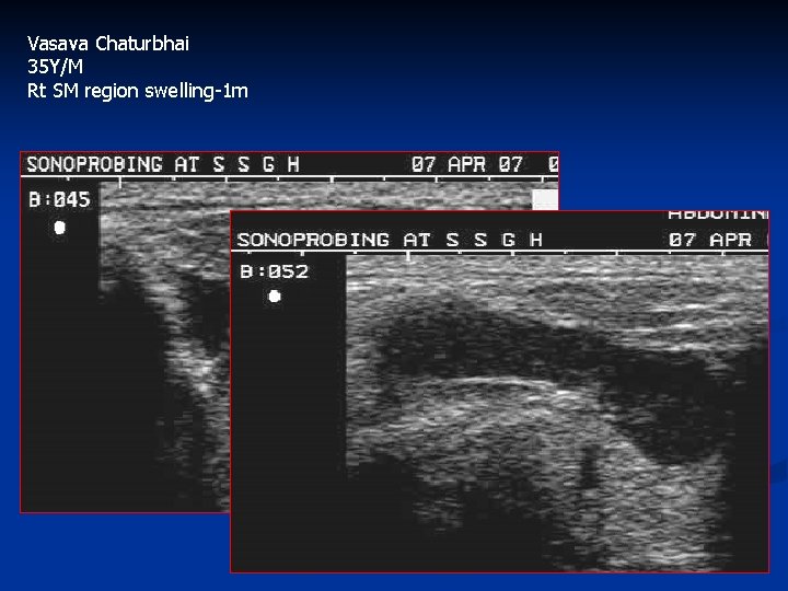 Vasava Chaturbhai 35 Y/M Rt SM region swelling-1 m 