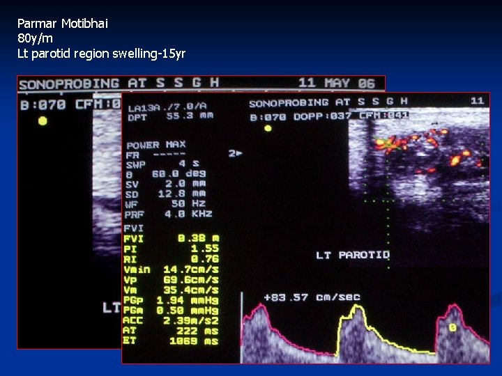Parmar Motibhai 80 y/m Lt parotid region swelling-15 yr 