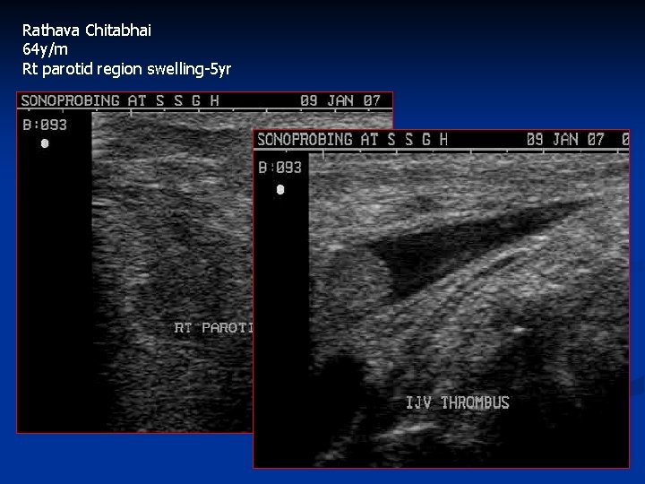 Rathava Chitabhai 64 y/m Rt parotid region swelling-5 yr 