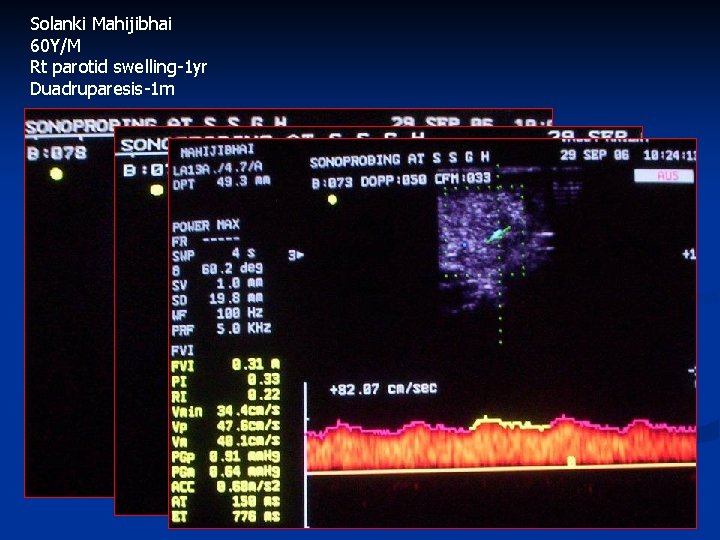 Solanki Mahijibhai 60 Y/M Rt parotid swelling-1 yr Duadruparesis-1 m 
