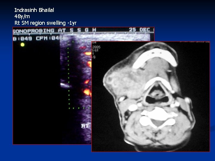 Indrasinh Bhailal 48 y/m Rt SM region swelling -1 yr 