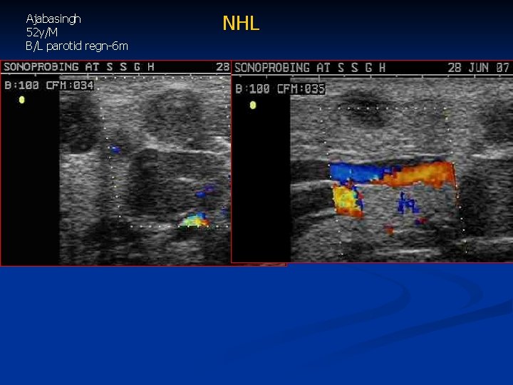 Ajabasingh 52 y/M B/L parotid regn-6 m NHL 