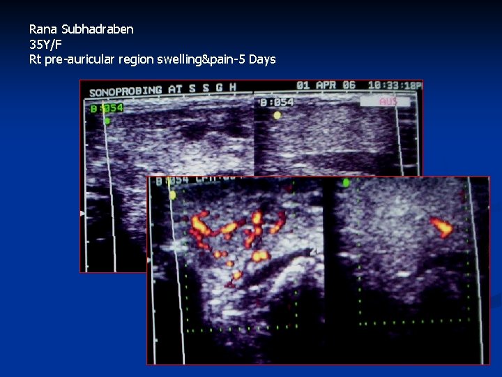 Rana Subhadraben 35 Y/F Rt pre-auricular region swelling&pain-5 Days 
