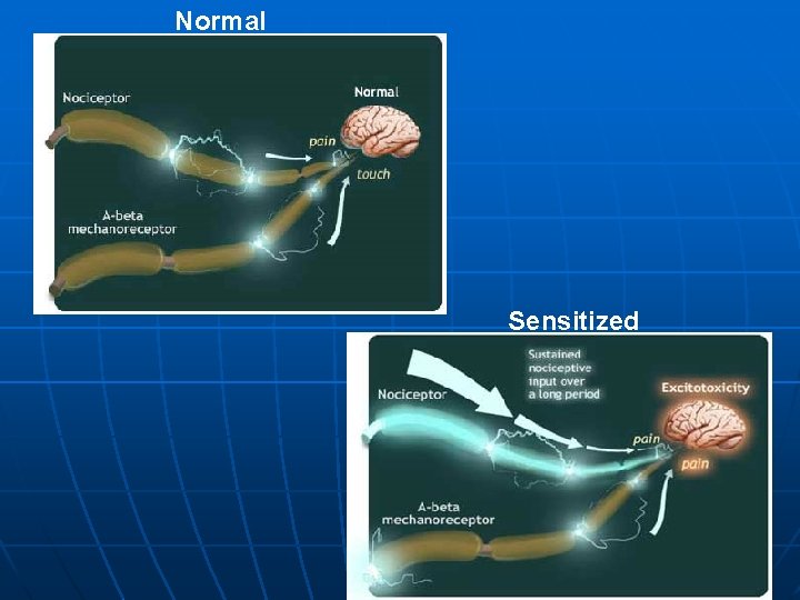 Normal Sensitized 