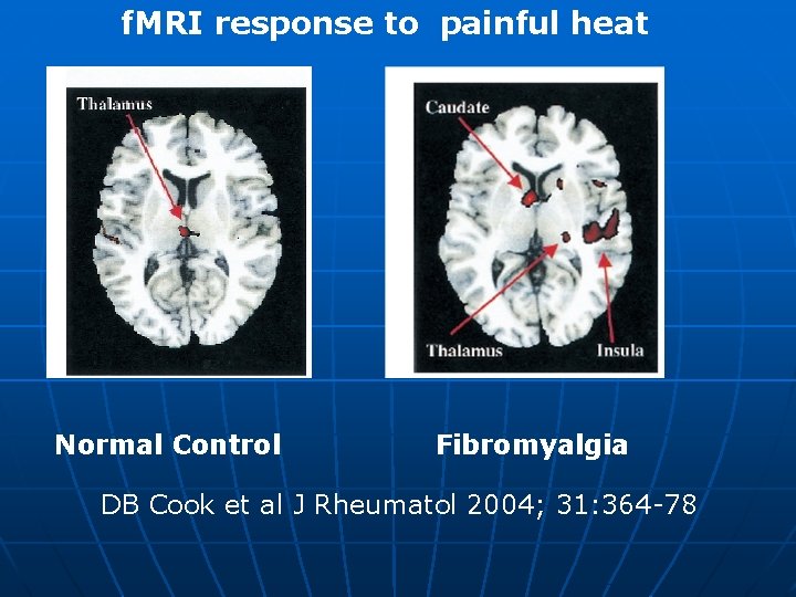 f. MRI response to painful heat Normal Control Fibromyalgia DB Cook et al J