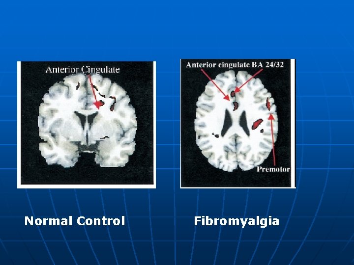 Normal Control Fibromyalgia 