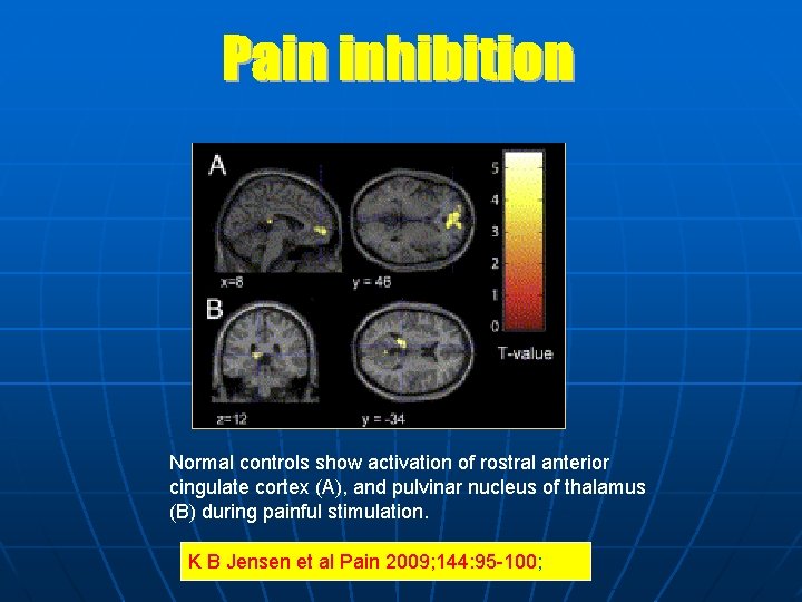 Normal controls show activation of rostral anterior cingulate cortex (A), and pulvinar nucleus of