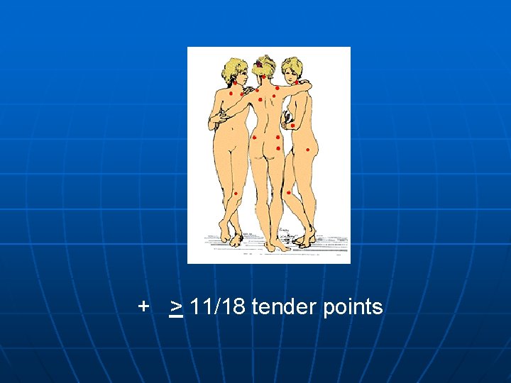 + > 11/18 tender points 