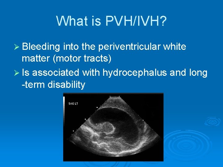 What is PVH/IVH? Ø Bleeding into the periventricular white matter (motor tracts) Ø Is