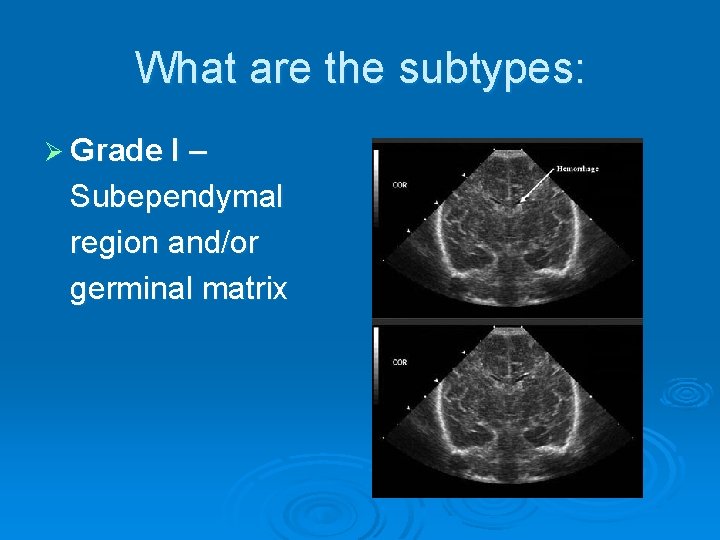 What are the subtypes: Ø Grade I – Subependymal region and/or germinal matrix 