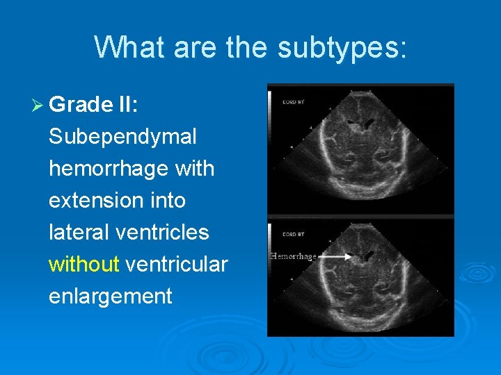 What are the subtypes: Ø Grade II: Subependymal hemorrhage with extension into lateral ventricles