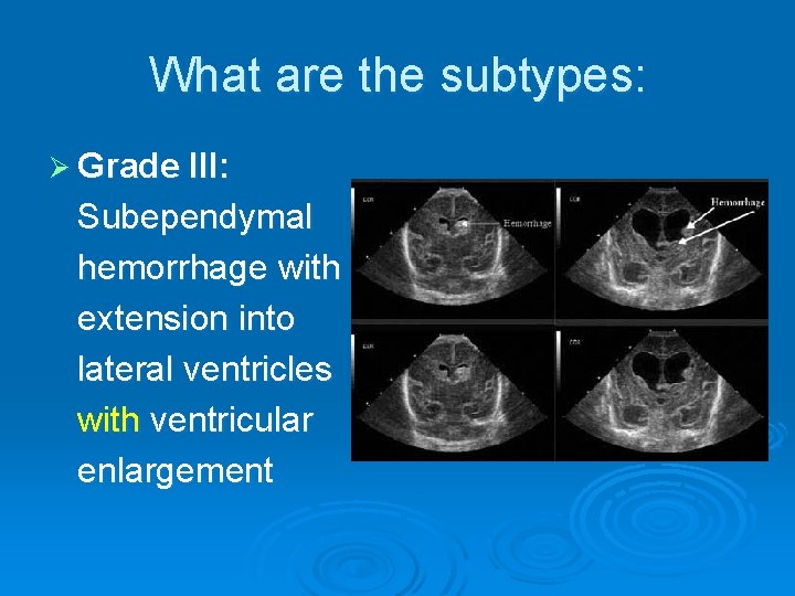 What are the subtypes: Ø Grade III: Subependymal hemorrhage with extension into lateral ventricles