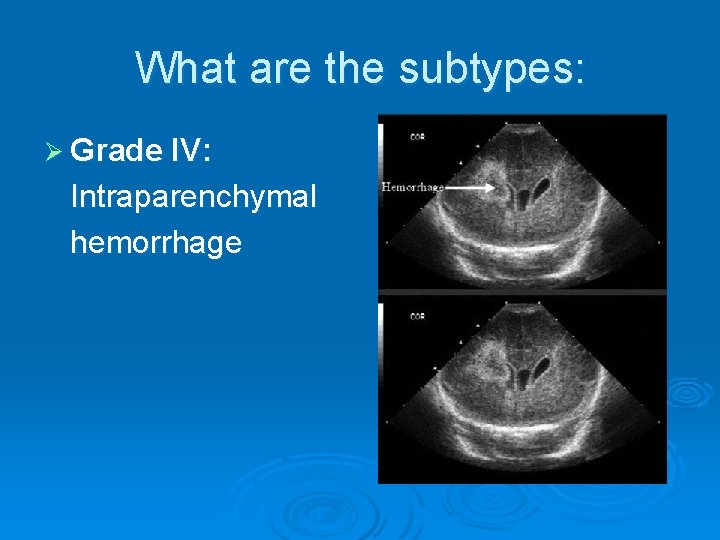 What are the subtypes: Ø Grade IV: Intraparenchymal hemorrhage 