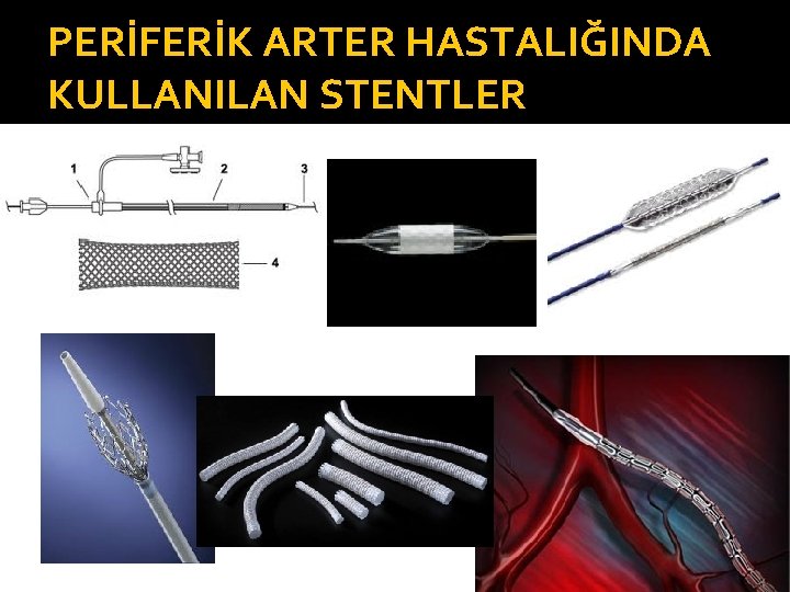 PERİFERİK ARTER HASTALIĞINDA KULLANILAN STENTLER 