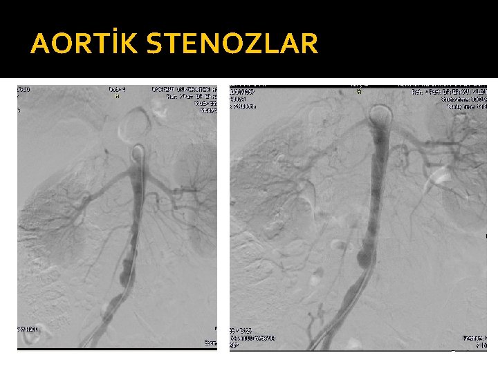 AORTİK STENOZLAR 