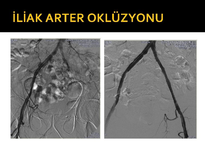 İLİAK ARTER OKLÜZYONU 