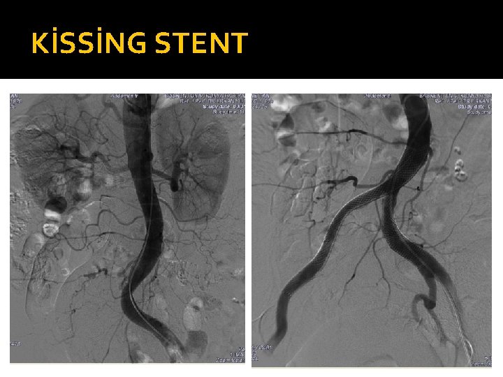KİSSİNG STENT 