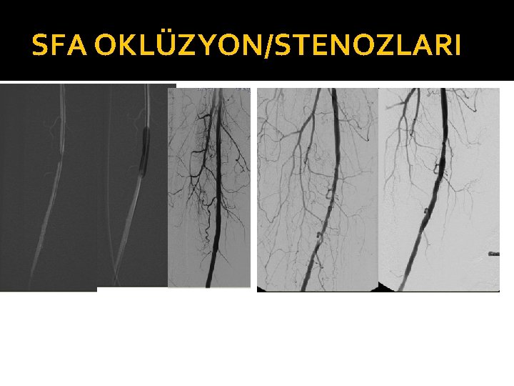 SFA OKLÜZYON/STENOZLARI 