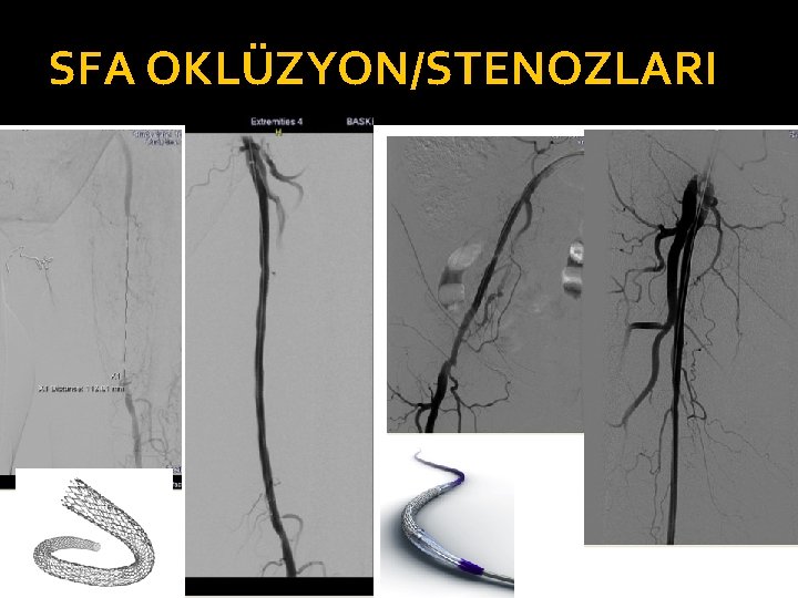 SFA OKLÜZYON/STENOZLARI 