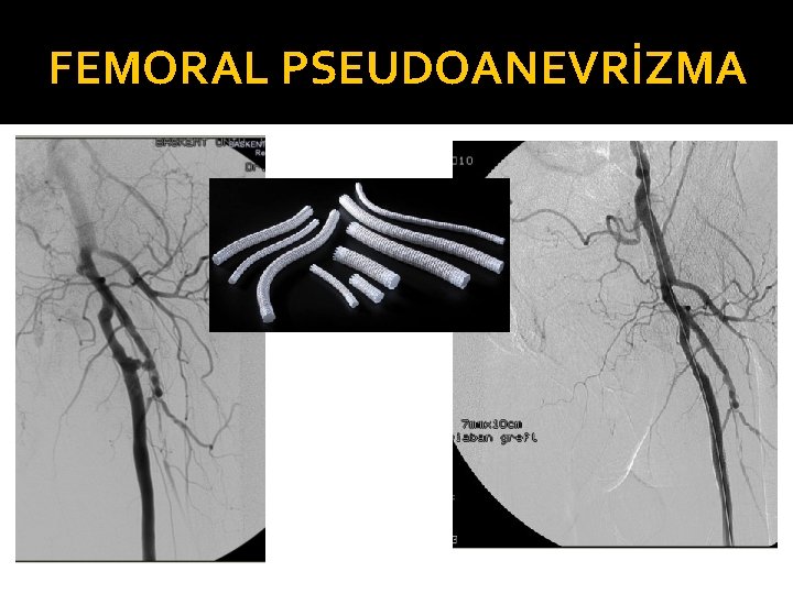 FEMORAL PSEUDOANEVRİZMA 