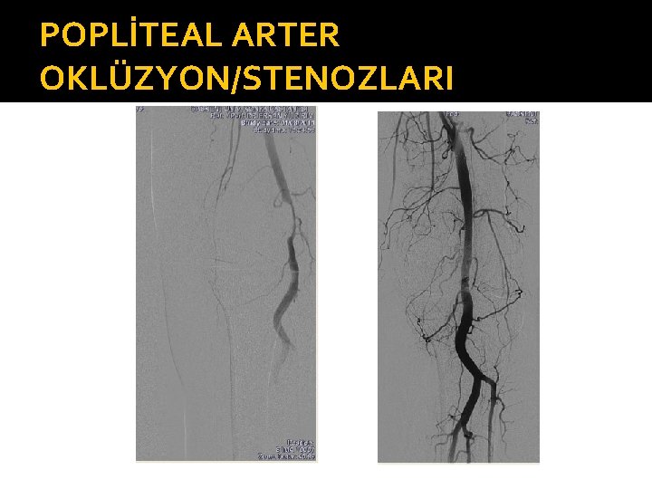 POPLİTEAL ARTER OKLÜZYON/STENOZLARI 