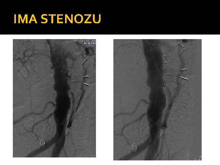 IMA STENOZU 