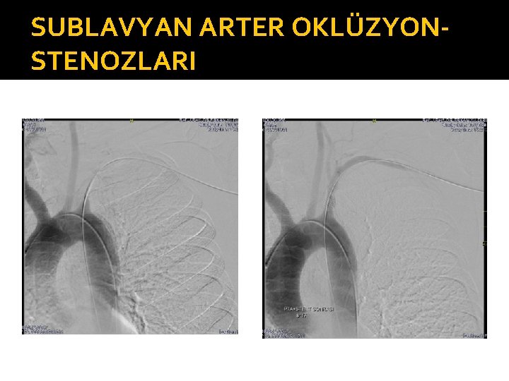 SUBLAVYAN ARTER OKLÜZYONSTENOZLARI 