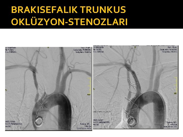 BRAKISEFALIK TRUNKUS OKLÜZYON-STENOZLARI 