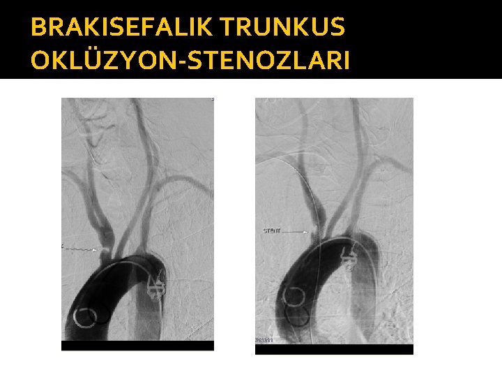 BRAKISEFALIK TRUNKUS OKLÜZYON-STENOZLARI 