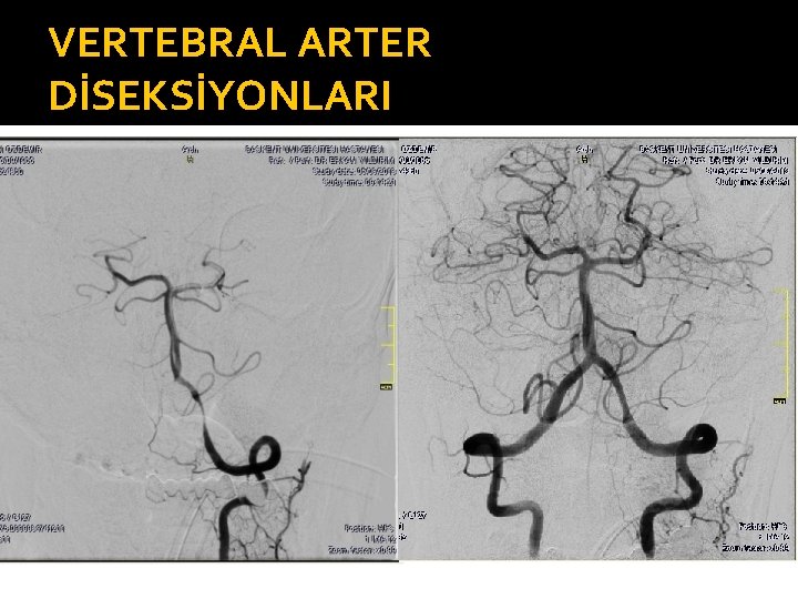 VERTEBRAL ARTER DİSEKSİYONLARI 