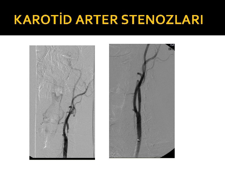 KAROTİD ARTER STENOZLARI 