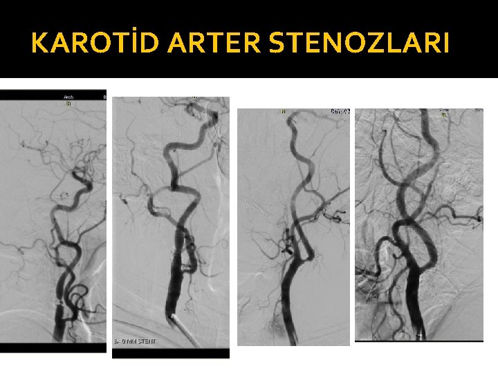 KAROTİD ARTER STENOZLARI 