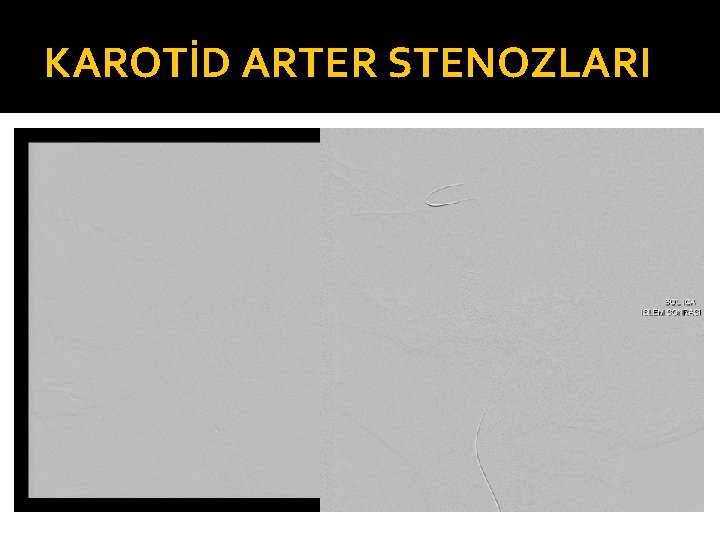 KAROTİD ARTER STENOZLARI 