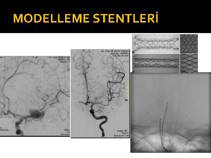 MODELLEME STENTLERİ 