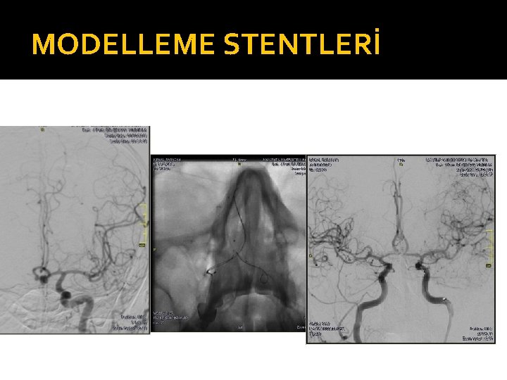 MODELLEME STENTLERİ 