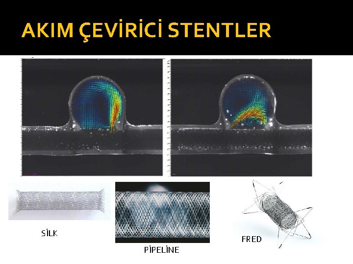 AKIM ÇEVİRİCİ STENTLER SİLK FRED PİPELİNE 